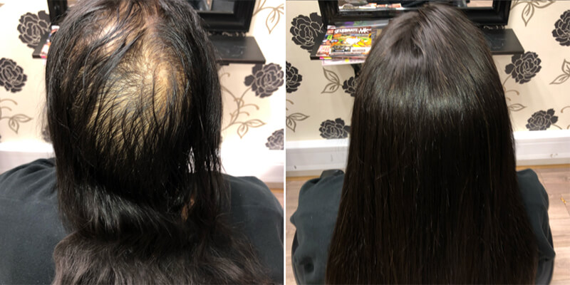 Hair Integration Before And After
