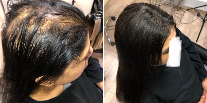 Hair Integration Before And After
