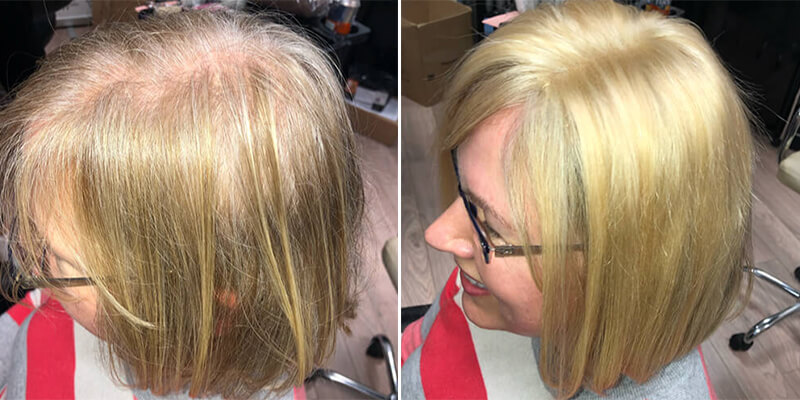 Hair Integration Before And After