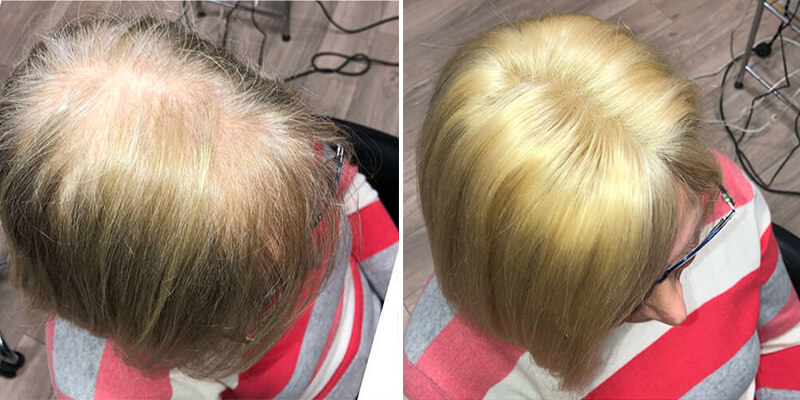 Hair Integration Before And After