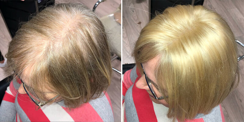 Hair Integration Before And After