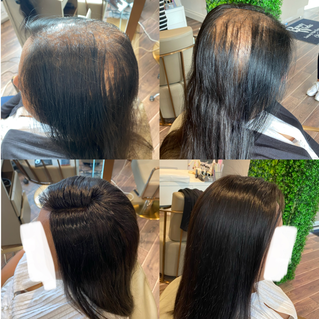 Hair Replacement Systems Mesh Integration System